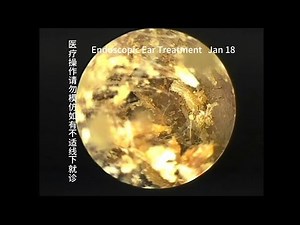 Treatment of Cerumen Embolism in Children's External Ear Canal 20240118