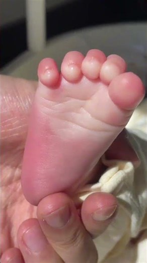 planter grasp reflex