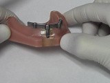 Implant Bar Overdenture - Model Demonstration • Video • MEDtube.net