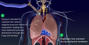 UF Health among first in world to use novel diaphragmatic pacer to help COVID-19 patients breathe » Division of Pulmonary, Critical Care & Sleep Medicine » College of Medicine » University of Florida