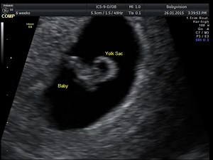 1K views | What can I see at 6 weeks? Watch the video below as to what you can expect to see at a 6 week scan. We can see the gestation (pregnancy) sac, the yolk sac, the baby (fetal pole) and the heartbeat. The baby will be measured from the top of the head to its bottom this is known as the Crown Rump Length (CRL). By measuring the CRL we can tell you how big baby is in mm and therefore how many weeks and days pregnant you are. | Babyvision | Facebook