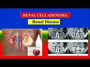 RENAL CELL ADENOMA - Explained | Causes, Symptoms, Diagnosis & Treatment Explained