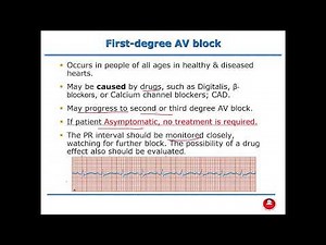 Critical Care Nursing - ECG Part 3: Atrioventricular Blocks