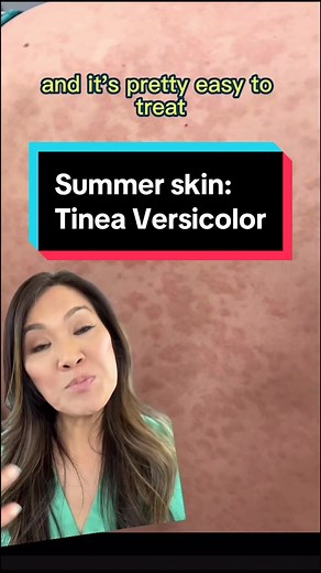 Understanding Tinea Versicolor: Causes, Symptoms, and Treatments