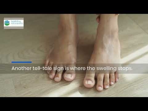 Lipedema vs Lymphedema: Key Signs for a Faster Diagnosis