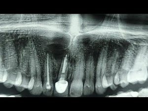 Nasolabial cyst and periapical under L.A by Dr. Mohamed Elshamaa