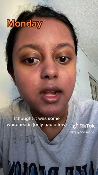 Malassezia Folliculitis Treatment: My 1-Week Journey