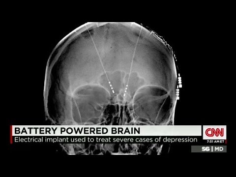 Deep brain stimulation treats depression