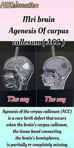 Agenesis / mri brain / corpus callosum