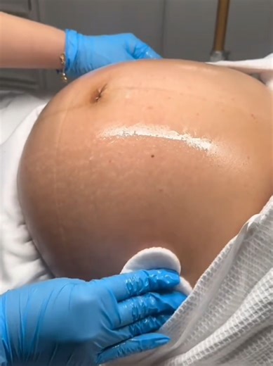 Belly Facial Pendant la Grossesse : Bienfaits et Détails