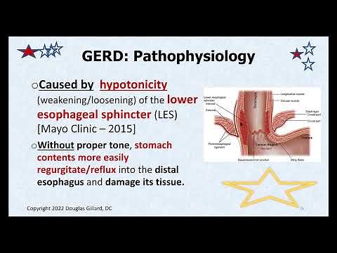 Heartburn: a Deep Dive into Gastroesophageal Reflux Disease (GERD)