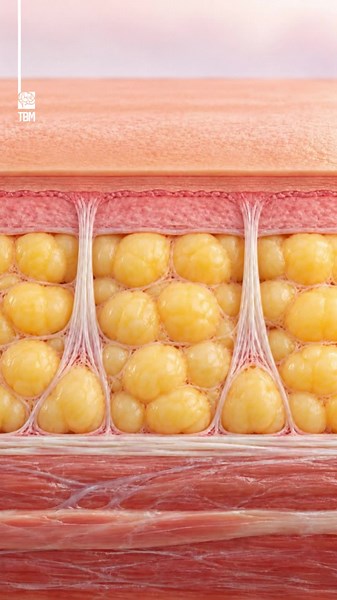 What Causes Cellulite? - What causes cellulite, and why can it appear even with very little body fat? See what happens beneath the skin.