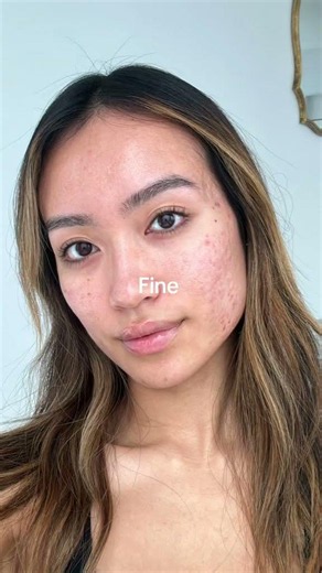 I healed my acne naturally ! (After 10 years of trial and error)