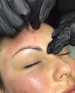 1.9K views | Micro-needling causes a wound healing response in the...