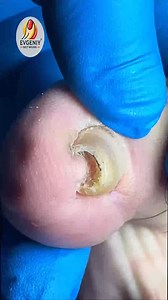 1.9K views | Natural Nail Solutions for Curved Nails That Reduce Pain Naturally #ToenailRoutine #SimpleNailCare #NailCareTips #CleanNailsDaily | Evgeniy | Facebook