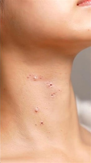 Neck Blackhead Vacuum Extraction – Satisfying Deep Clean