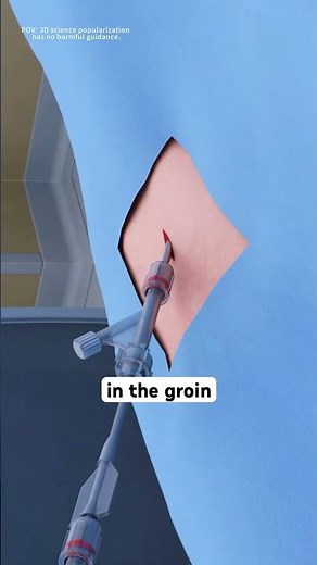 Mechanical thrombectomy procedure (3D animation)