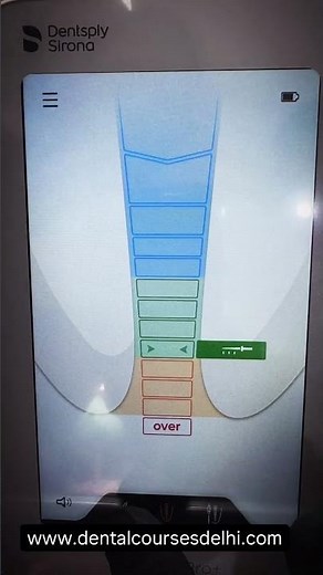 X Smart Pro+ in Action 🔥 Ultimate Precision for Perfect Root Canals | Endo Game Changer