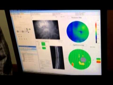 OptoVue SD OCT Glaucoma Protocol