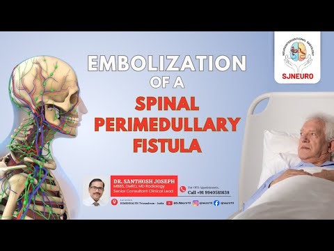 Embolization of Spinal Perimedullary Fistula | Advanced Catheter-Based Neurointervention