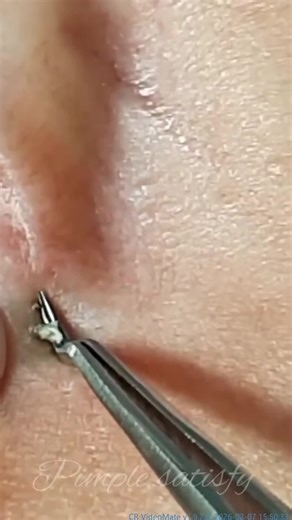 Satisfying Pimple Popping Compilation