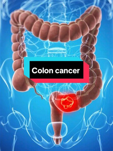 Recognizing Colon Cancer Symptoms When Using the Washroom
