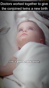 3.7K views · 22 reactions | Doctors worked together to give the conjoined twins a new birth | Miniturros | Facebook