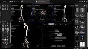 17K views · 237 reactions | CT angiogram of lumber spine filming...
