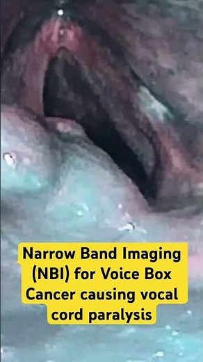Narrow Band Imaging ( NBI) for Voice Box Cancer Diagnosis causing Vocal Cord Paralysis