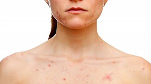 Does Acne Laser Treatment Work?