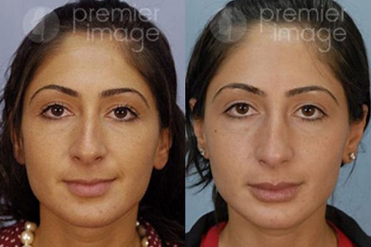 Dermal Fillers in Atlanta, GA | Dr. Louis DeJoseph