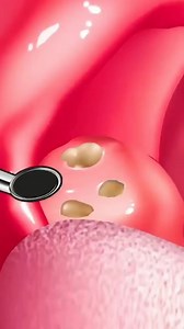 Infected mouth stone tretment Removal care | #treatment #cleaning #video #reels #shorts #asmr #3d | Akhilesh Yadav