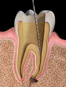 Endodontics: Apexification