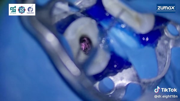 Apical Canal Treatment: Removing GP and Sealer