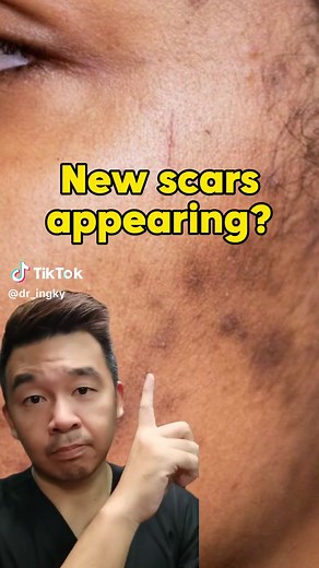 Reduce Scars with Vit C Serums & Retinoids