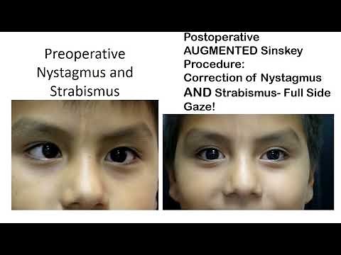 Pre and Post Operative findings for the Augmented Sinskey Procedure for nystagmus