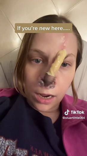 Cocaine Nose Reconstruction: Understanding the Forehead Flap Procedure