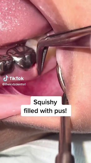 Teeth get pimples too🔴! This is called a tooth “abscess” & occurs when the tooth becomes infected⚠️ Taking antibiotics does not 100% resolve these types of abscesses on baby teeth. Only option: remove the tooth to get rid of the infection or it can get much worse! Severe pain & facial swelling can occur. A space maintaner also needs to be placed to ensure the permanent tooth has space to errupt correctly. Parents: if you see this type of bump, see a dentist ASAP! #tooth #teeth #dentist teeth cl