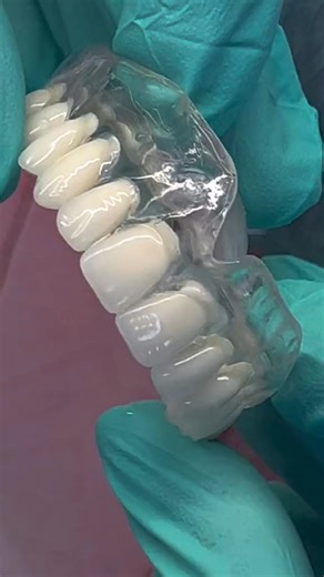 Dentiers Invisibles En France Une Vue D Ensemble Informative | PR Info Hub