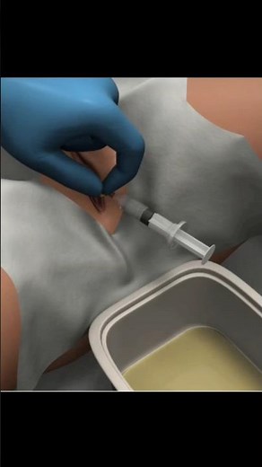 Female Catheterization: The Correct Technique Doctors Must Know! #Medical #Nursing #Skills