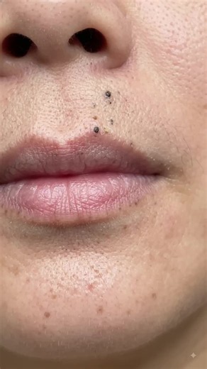 black heads remove for lips. #removeblackheads #facecleaning #creatorsearchinsights #faceclean #viral #foryou
