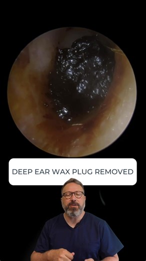 Deep Ear Wax Plug Removal Process
