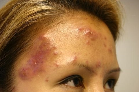 The Acne Practice (severe case 5)