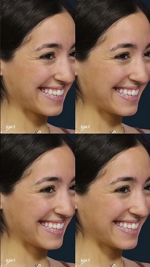 Botox Before & After That's Actually Real #beforeandafter #botox #authentic