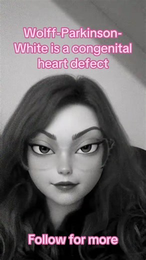 What is Wolff-Parkinson-White?#wpwsyndrome #wpw #wolffparkinsonswhitesyndrome #heartdefect