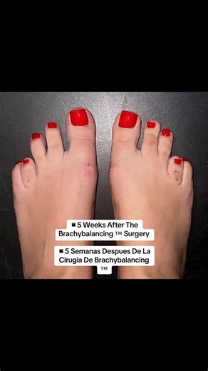Dr. Abraham Wagner on Instagram: "BRACHYBALANCING™, a pioneering development co-created by Dr. Orlando Nunez and Dr.Abraham Wagner, marks a significant advancement in the treatment of brachymetatarsia, meticulously addressing both its functional and aesthetic elements. Through this surgical approach, we not only rectify the underlying brachymetatarsia but also address related foot deformities, striving to achieve a more visually balanced and harmonious appearance. This approach embodies a new er