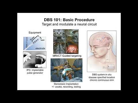 Deep Brain Stimulation for Treatment-Resistant Depression: A Progress Report