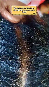 Head lice do not have wings and do not jump. #Lice #LiceProblem #LiceAttack #NoMoreLice #AsmrVideo #Hair #LiceTreatment #LiceSolution #LiceRemovalTips | Ahmad