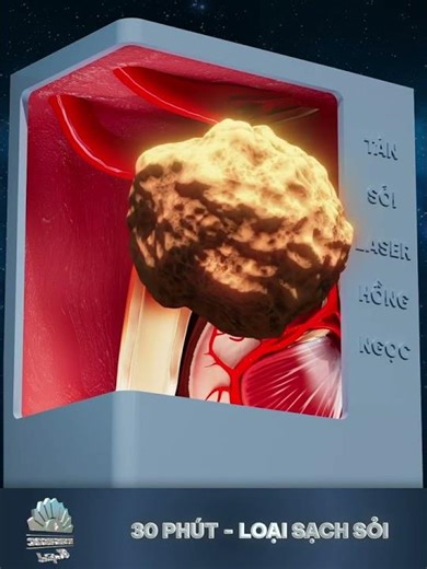 3D Medical Animation Showcase | Laser Kidney Stone Treatment - Hong Ngoc Hospital Ads