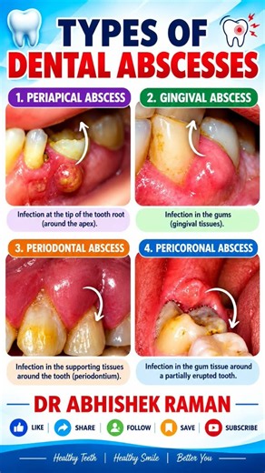 #dental #abscess #dentist #dentalreels #endodontic #periodontics #dentista #yt #trending #education